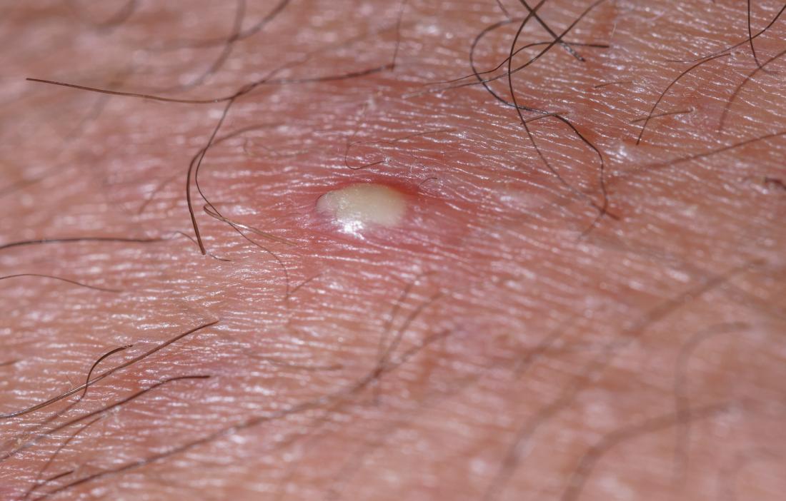 hard white spots on scrotum